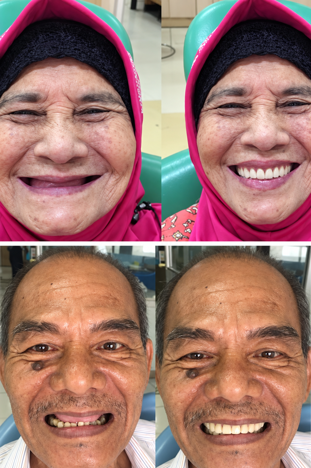 Contoh hasil perawatan gigi palsu sebelum dan sesudah